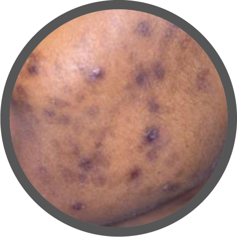 Types of dark spots_Postinflamatorias Melasma